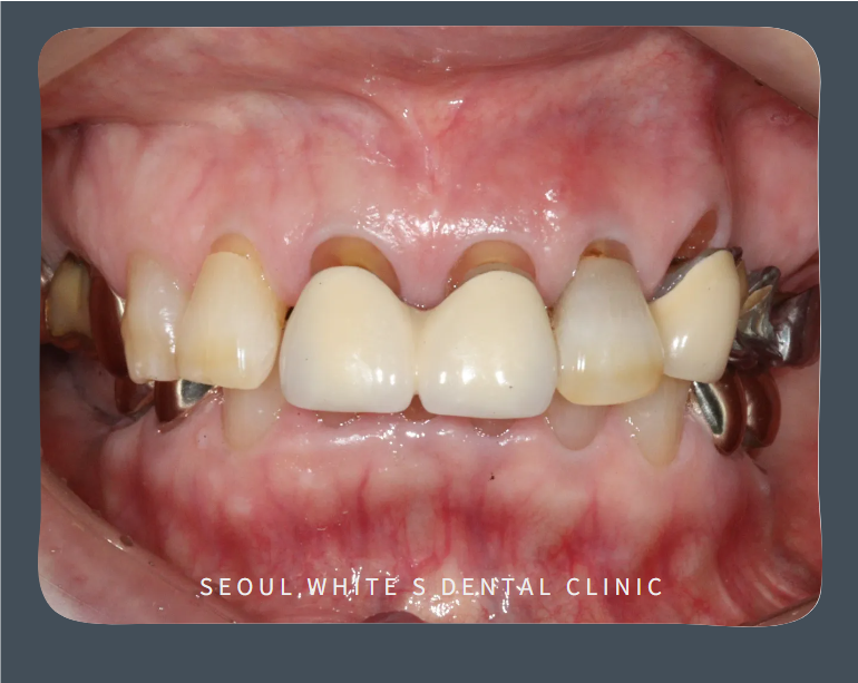 남항동심미보철