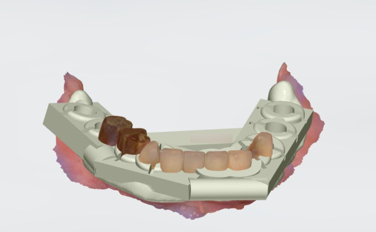 대교동임플란트