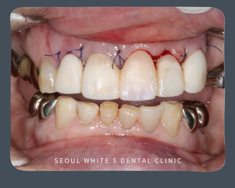 남항동심미보철