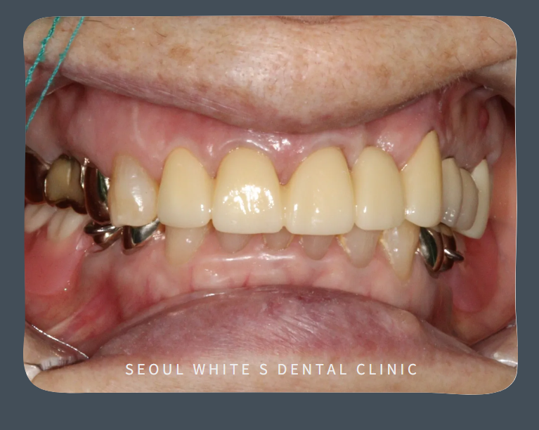 남항동심미보철