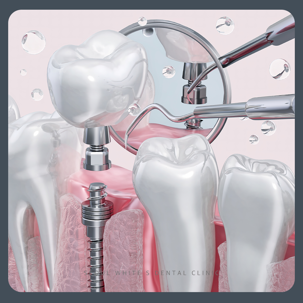 대교동임플란트