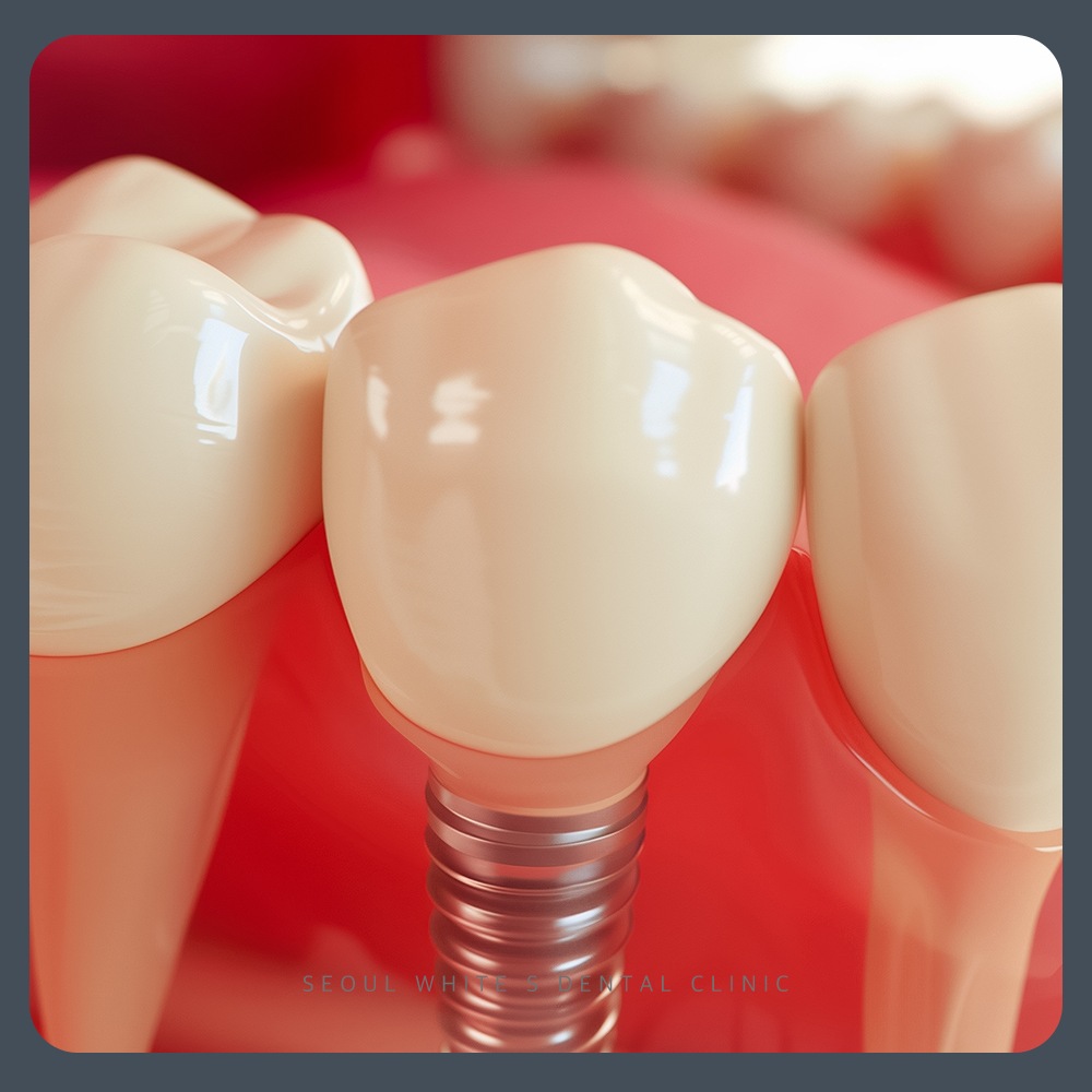 대교동임플란트