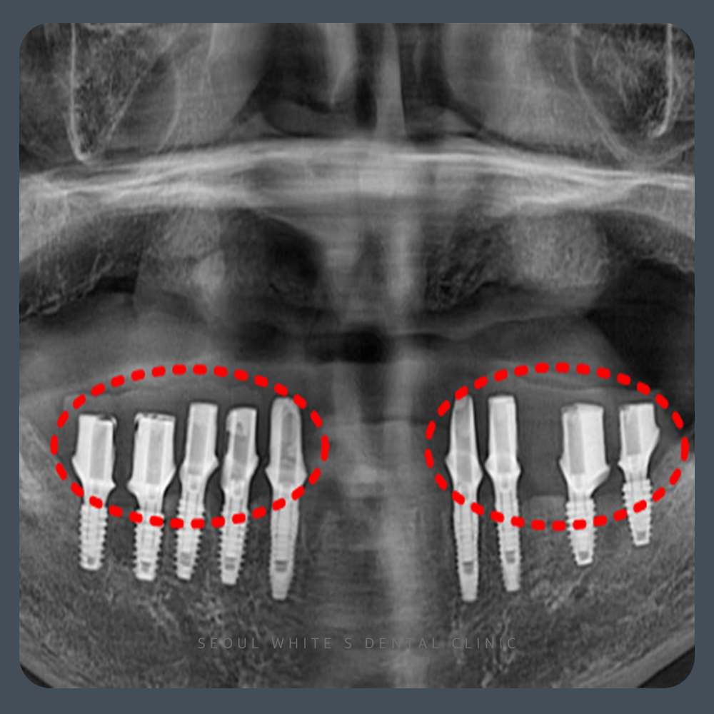 대교동임플란트