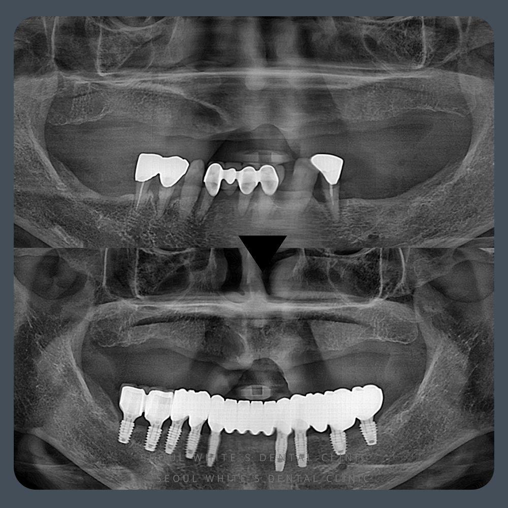 대교동임플란트