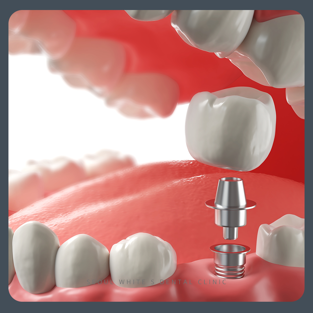 대교동임플란트