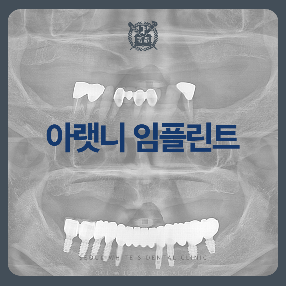 대교동임플란트