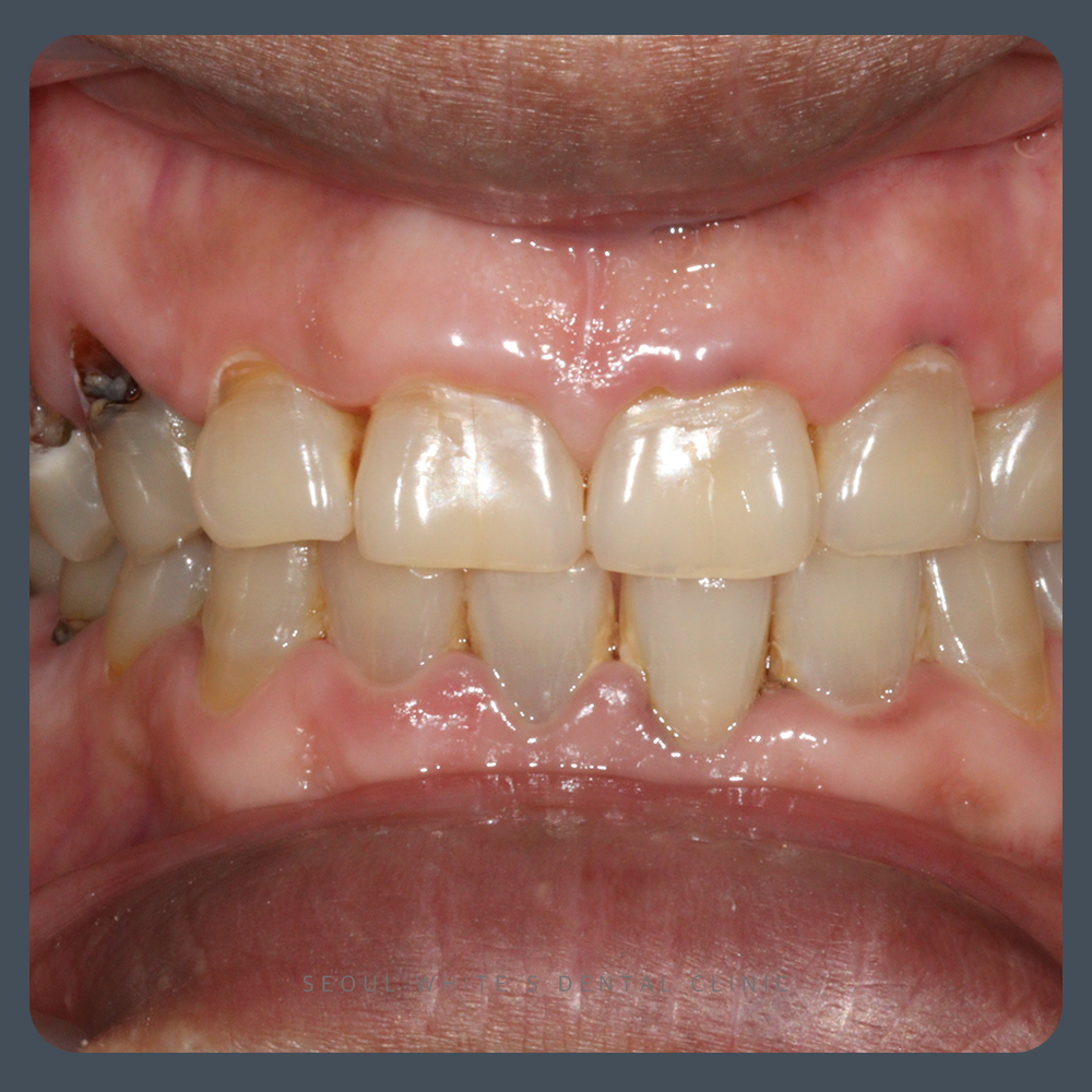 영선동잇몸치료