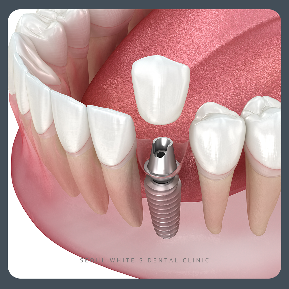 영도구임플란트