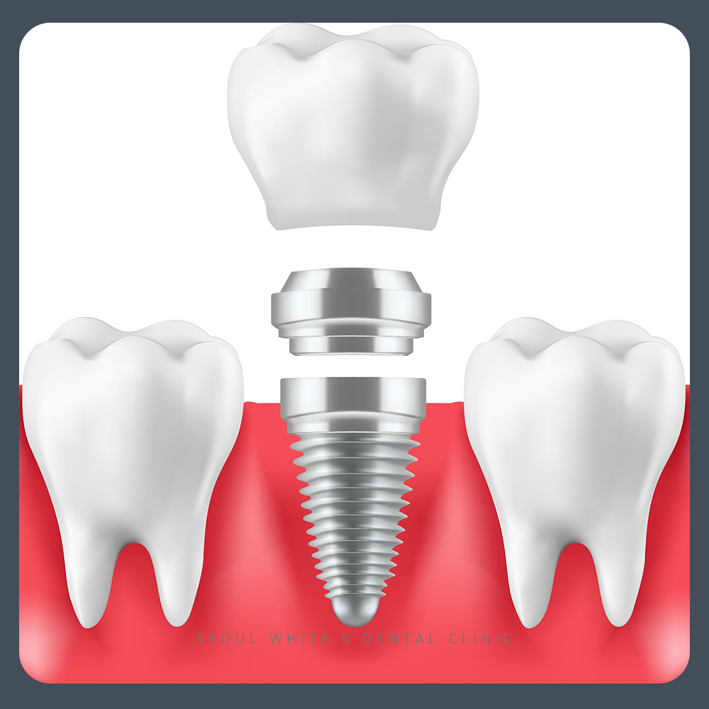 영도구임플란트