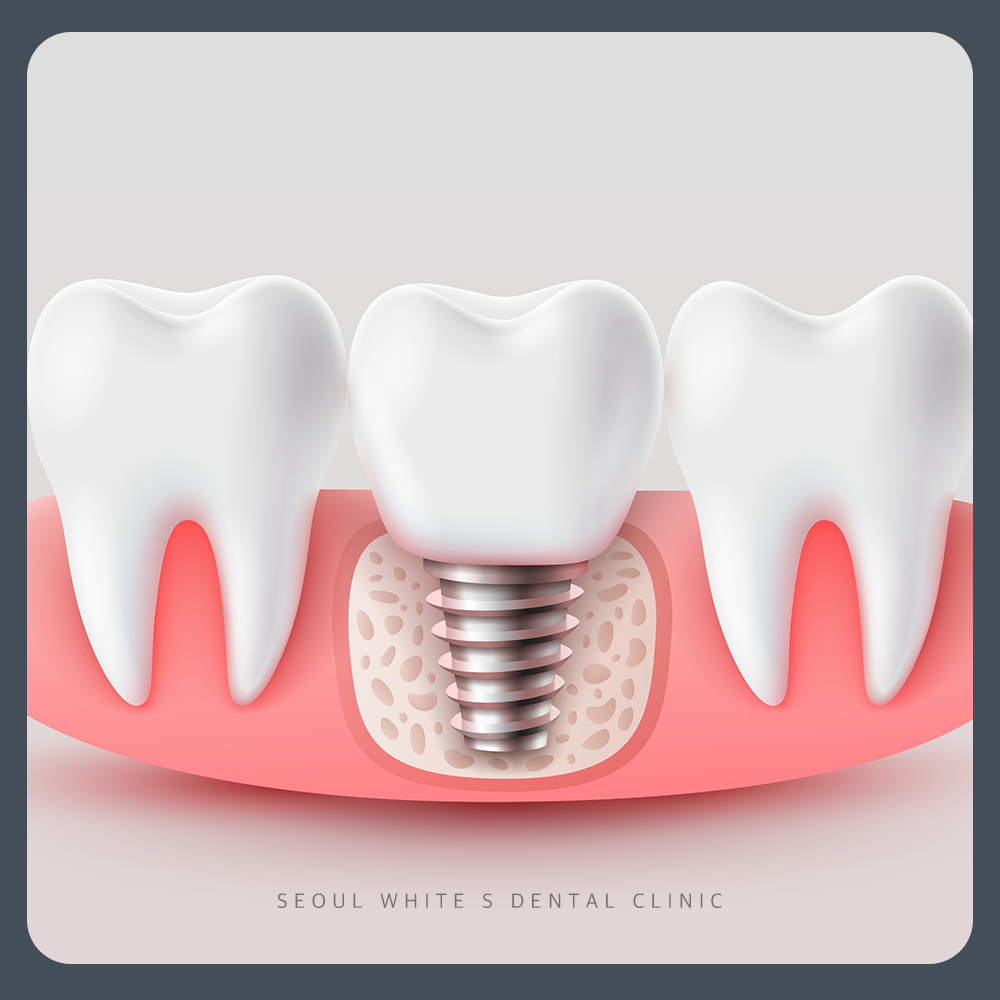 영도구임플란트