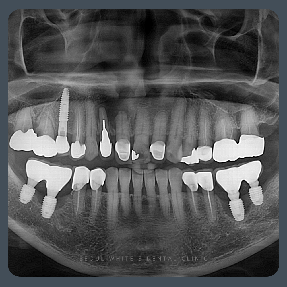 영도구임플란트