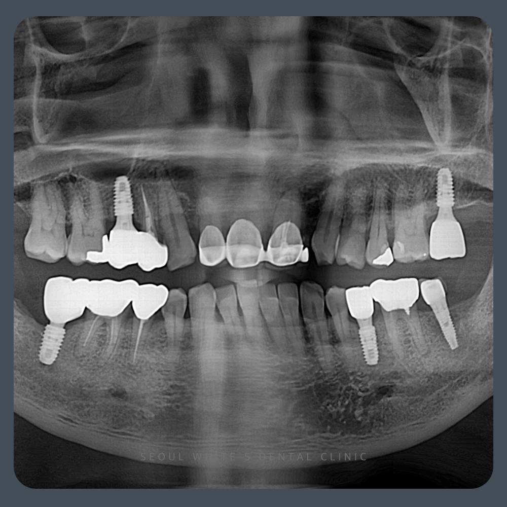 영도구임플란트