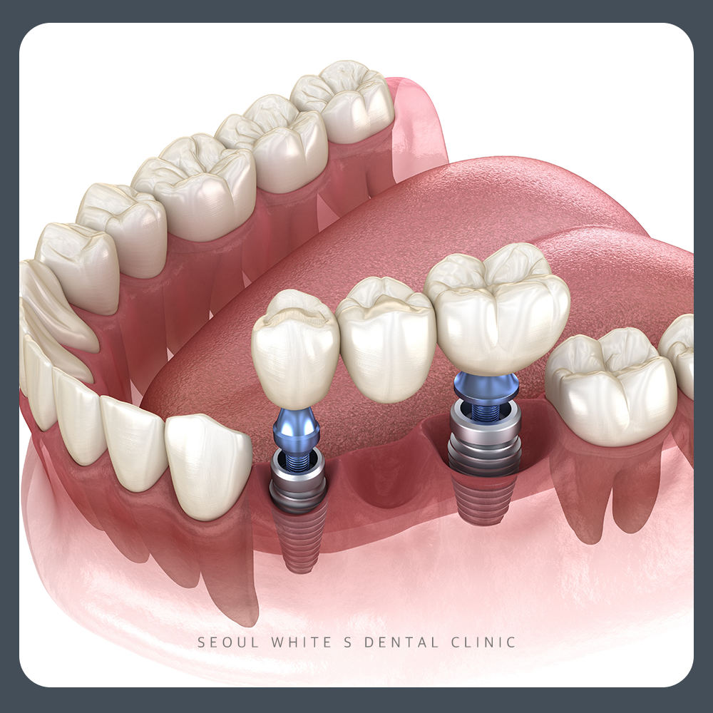 남포동임플란트