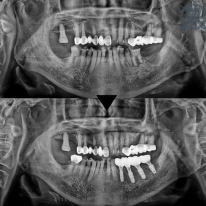 남포동임플란트