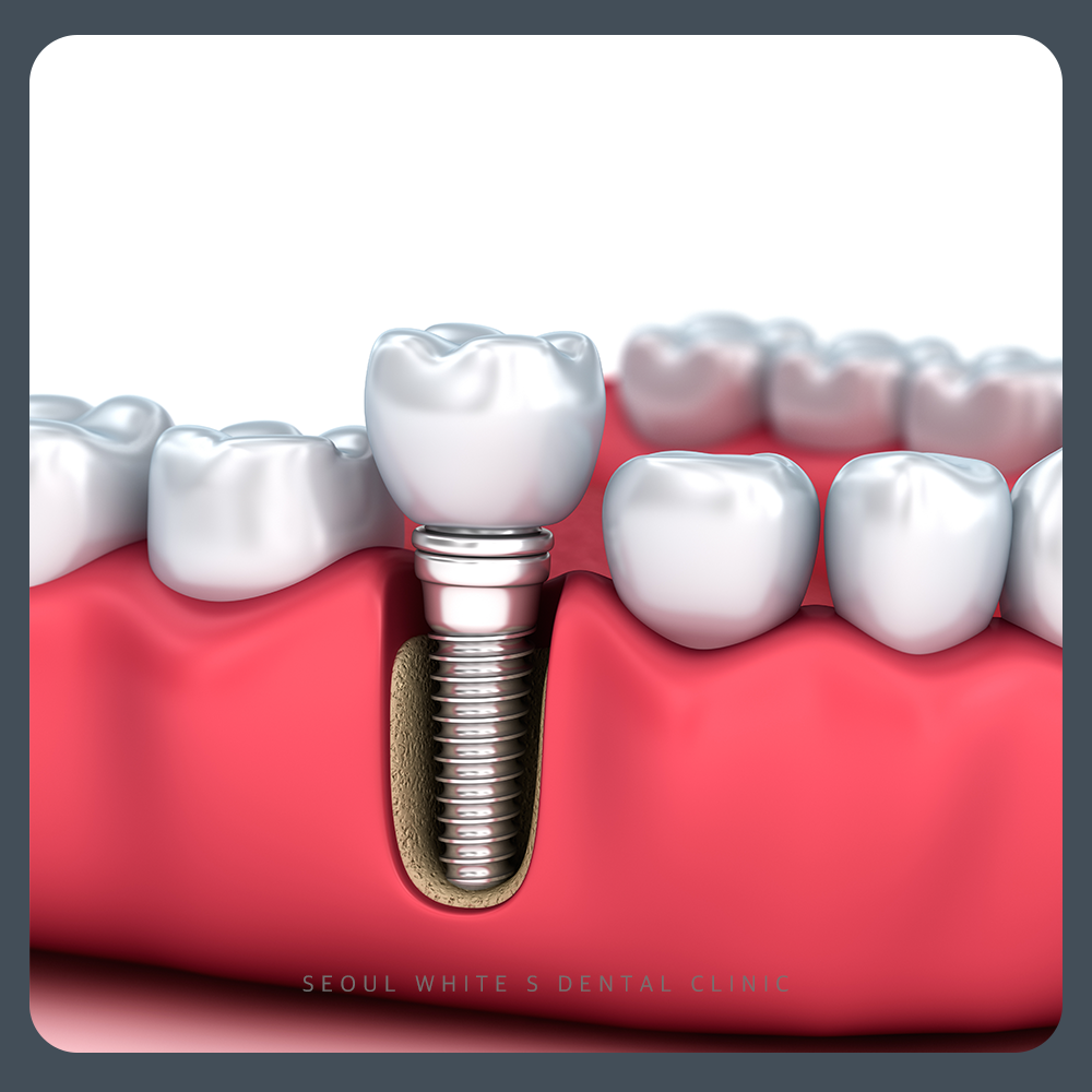 남포동임플란트