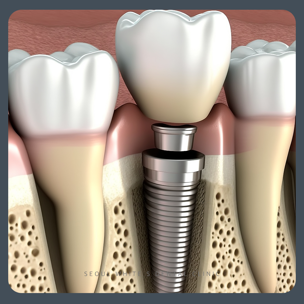 남포동임플란트
