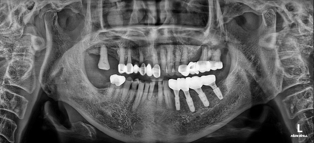 남포동임플란트