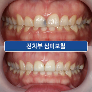 대교동심미보철